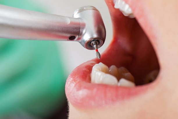 Best Knocked-Out Tooth (Avulsed Tooth) Treatment in Warsaw, KY